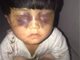 贵州4岁女童遭家人虐待续:生父被刑拘 继母哺乳期取保候审